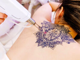 ¿Cómo se puede borrar un tatuaje?