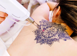 ¿Cómo se puede borrar un tatuaje? ¿Cómo se puede borrar un tatuaje?