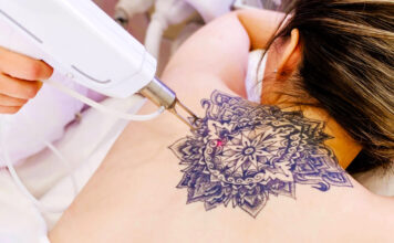 ¿Cómo se puede borrar un tatuaje? ¿Cómo se puede borrar un tatuaje?