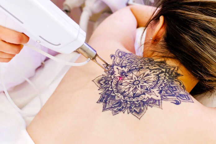 ¿Cómo se puede borrar un tatuaje?