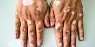 Come estos alimentos y mejorarás tu vitíligo Come estos alimentos y mejorarás tu vitíligo