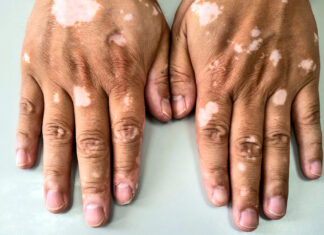 Come estos alimentos y mejorarás tu vitíligo Come estos alimentos y mejorarás tu vitíligo